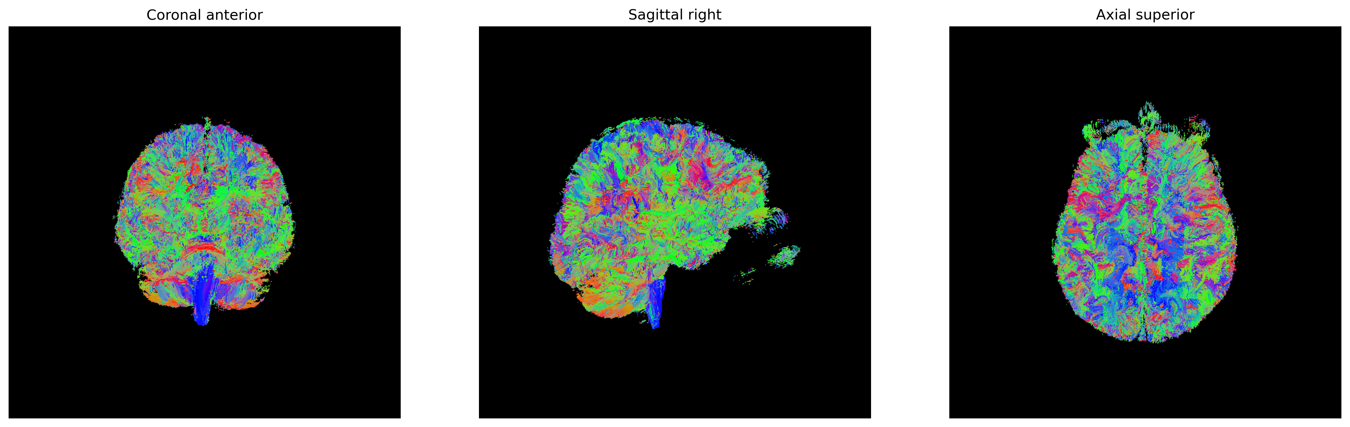 EuDX Determinsitic Tractography