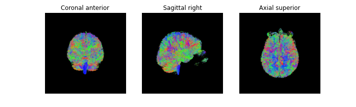 Binary Stopping Criterion Tractography