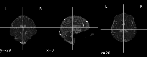 Axial diffusivity map