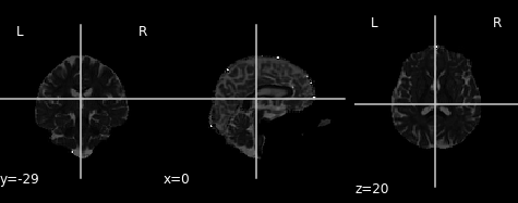 Radial diffusivity map